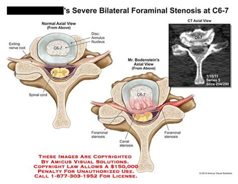 Amicus Illustration Of Amicus Injury Severe Bilateral Foraminal