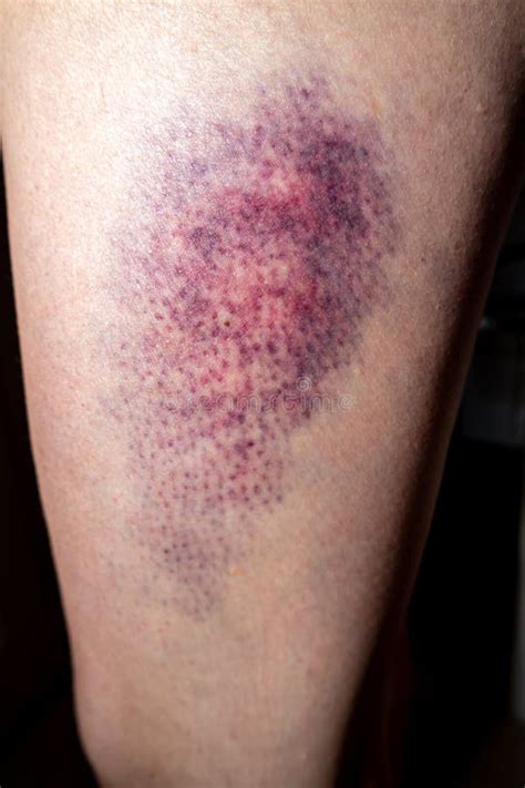 Terrible Bruise On The Upper Leg Of A Woman Stock Image Image Of Medicine Damage 243835629