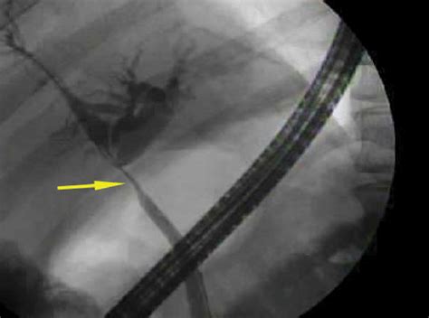Ercp Reveals A Tight Stricture Involve Common Hepatic Duct With