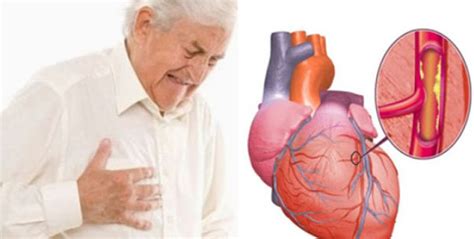 Fakta Sehat Bentuk Bentuk Gejala Penyakit Jantung Myocardial Infarction