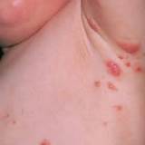 Home Remedies Scabies Humans