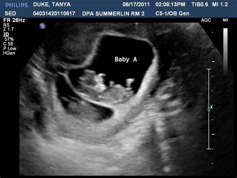 Week 10 Ultrasound Duke Twins