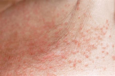 Heat Rash All You Need To Know In 8 Photos Riset