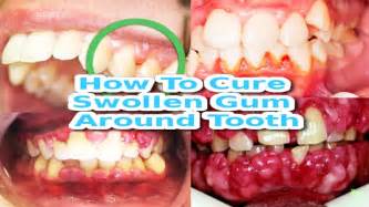 Wisdom tooth extraction in wakad wisdom teeth, wisdom from in.pinterest.com. How To Cure Swelling Gums Fast | How To Cure Swollen Gum ...