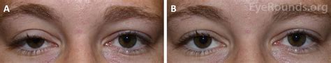 phenylephrine response in upper eyelid ptosis