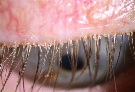 Bay Eye Care — Could You Have Mites Growing In Your Eyelashes