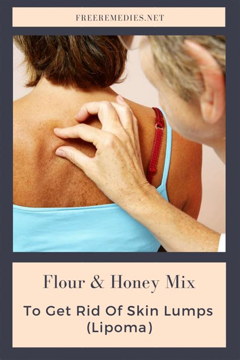 Flour And Honey Mix To Get Rid Of Skin Lumps Lipoma Freeremedies