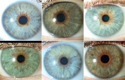 Eye Color Change Keratopigmentation Versus Laser Depigmentation
