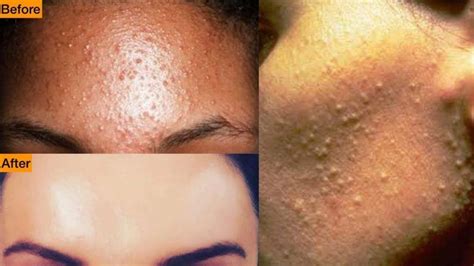 Get Rid Of Tiny Bumps On Face Acne Scar Mask Face Massage Remedies