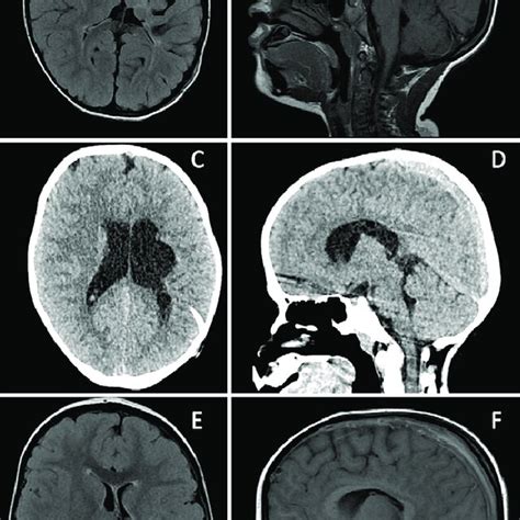 Radiographic Findings In Case 2 A And B Brain Mri Flair Sequence