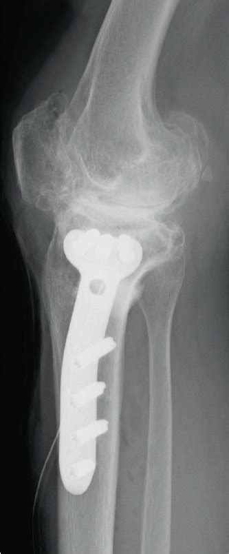 Postoperative Radiography Shows That Tibial Condyle Valgus Osteotomy