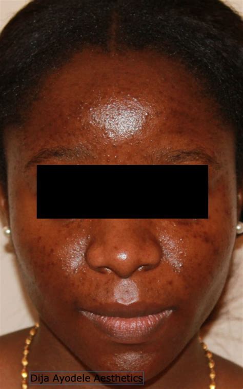 The good news is that skin hyperpigmentation isn't dangerous and hyperpigmentation treatment can help rejuvenate skin. What no one tells you about chemical peels for black skin