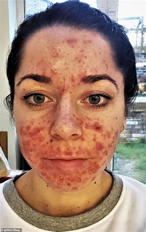 Personal Trainer Who Had The Worst Acne Ever Seen Shares Her Striking
