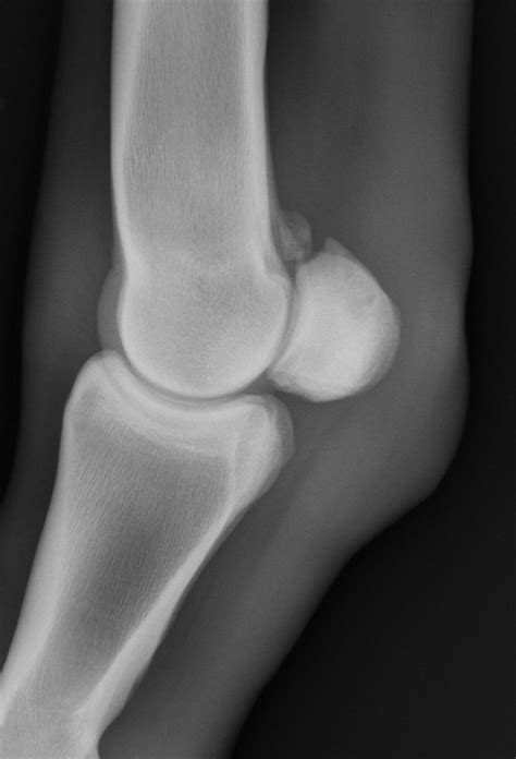 Diagnosis And Management Of Proximal Sesamoid Bone Fractures In The