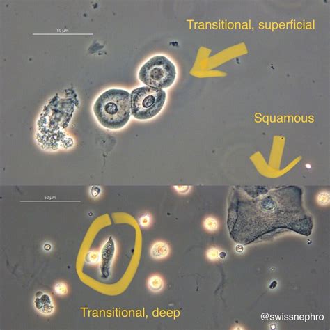 Celulas Epiteliais Na Urina Gestante