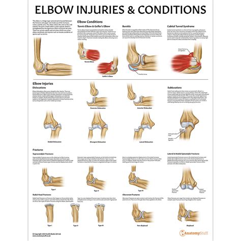 Elbow Injuries And Conditions Anatomy Poster Pathological Anatomy Chart