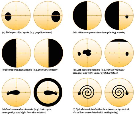 Non Glaucomatous Bilateral Visual Field Defects A Enlarg Flickr