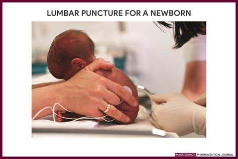 Lumbar Puncture Spinal Tap Nursing Responsibilities Nurseslabs