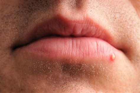 How To Identify A Herpes Cold Sore Vs Pimple — Expert Advice Girl Beauty
