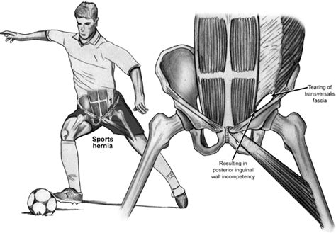 What Is A Sports Hernia Or Athletic Pubalgia International Surgery