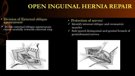 Laparoscopic Inguinal Hernia Surgery Anatomy