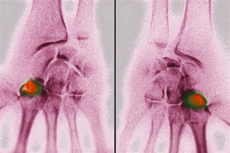 Kienbock S Disease X Ray Stock Image C Science Photo Library