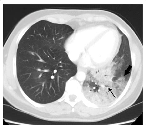 Adenocarcinoma In Situ Axial Contrast Enhanced Chest Ct Scan With Lung