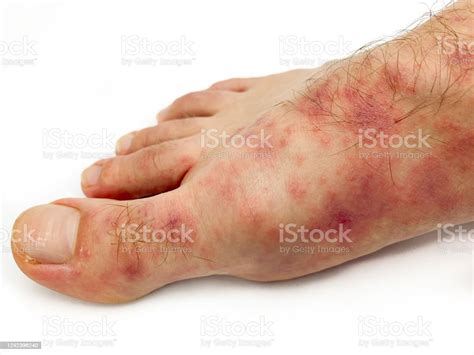 Close Up Of Males Foot And Toes With Red Rash Desease Isolated On A