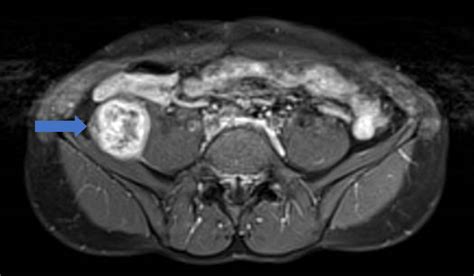 Cureus Retroperitoneal Knee Pain An Unusual Case Report And Review