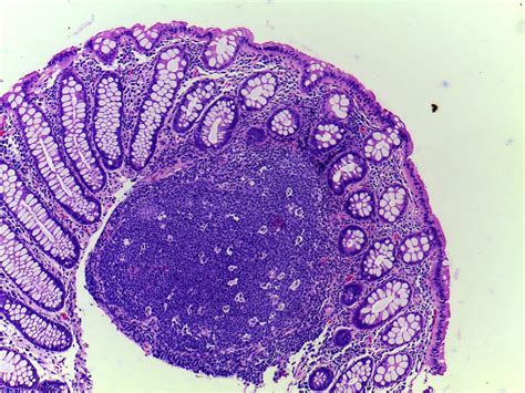 gastrointestinal and liver histology pathology atlas colon lymphoid polyp