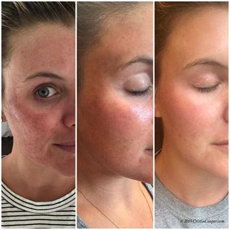 Laser Treatment And Microneedling Results The Southern Style Guide