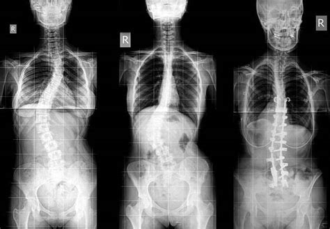 Early Onset Scoliosis Causes Symptoms Diagnosis And Treatment