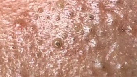 Deep Blackhead Extraction Cystic Acne And Pimple Popping 30 Youtube