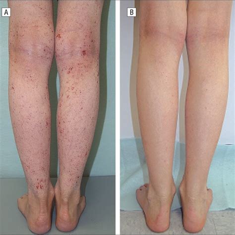 Patient 1 A Flare Of Atopic Dermatitis On Legs In March 2004 B