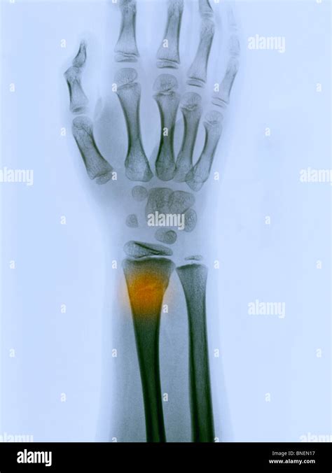 X Ray Showing A Greenstick Fracture Of The Distal Radius Stock Photo