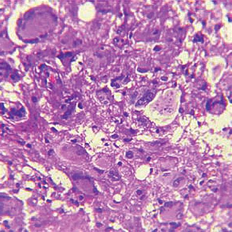 Giant Cell Glioblastoma Case 5 Pleomorphic Tumor Giant Cells