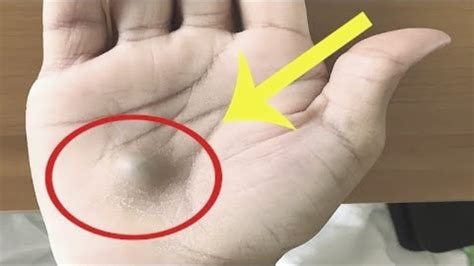 A Man Found This Strange Lump On His Palm Then A Scan Revealed The True