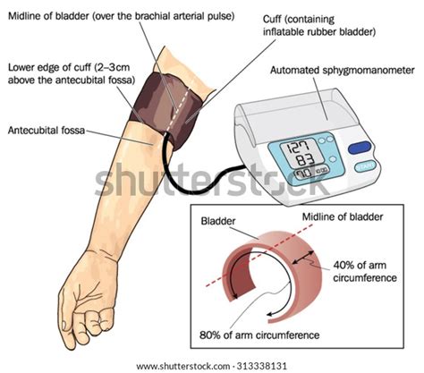 Blood Pressure Cuff On Arm Over Stock Vector Royalty Free 313338131