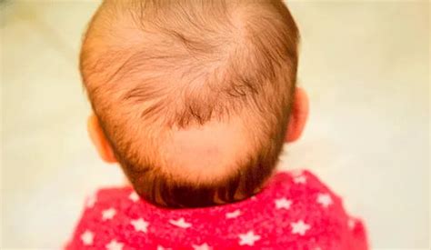 Alopecia areata en niños causas síntomas y tratamientos