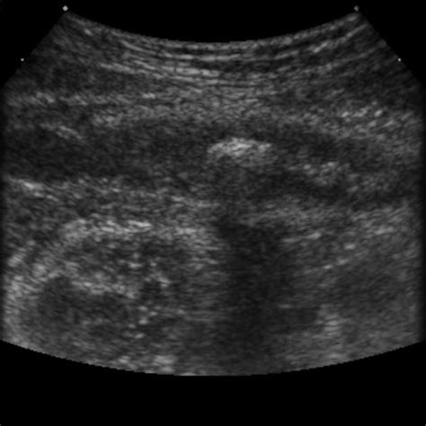 Appendicitis Radiology Reference Article
