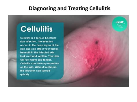 Diagnosing And Treating Cellulitis By Ziffytech07 Issuu