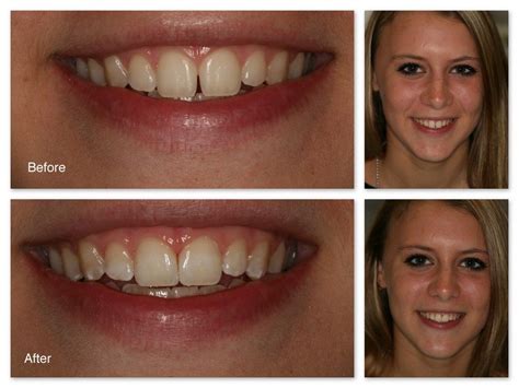 And, no, you don't necessarily need braces to do it. How to Close Teeth Gap without Expensive Braces (With ...