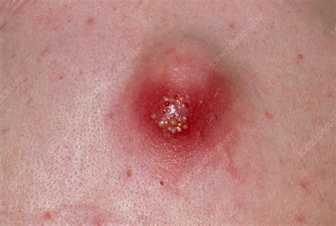 Close Up Infected Sebaceous Cyst On Back Stock Image M1300255