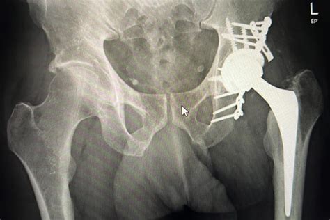 Complex Total Hip Replacements Hip And Knee Surgeon