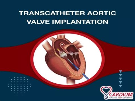 Ppt Transcatheter Aortic Valve Implantation Tavi Surgical