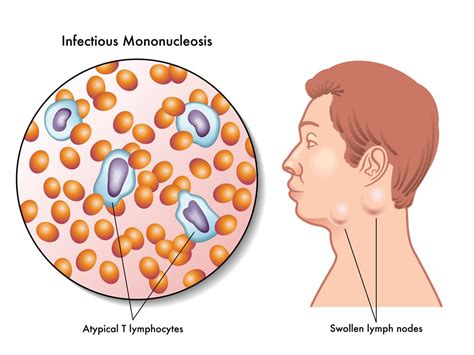 Mono Infectious Mononucleosis Overview Causes Symptoms Treatment