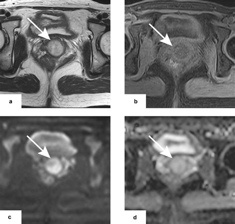 Superficial Myofibroblastoma Of The Vagina With A Stalk Case Report Of