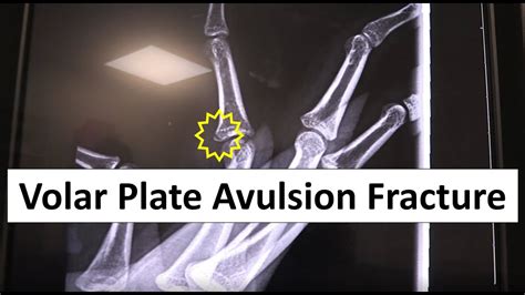 Volar Plate Avulsion Fracture Emergency YouTube