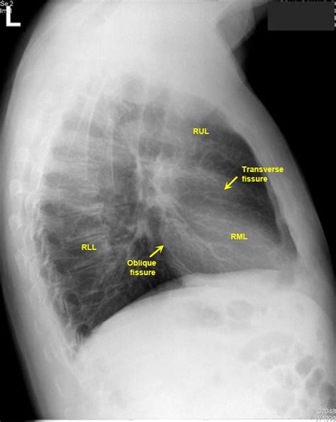 Untitled Document Oblique Fissure Radiography X Ray