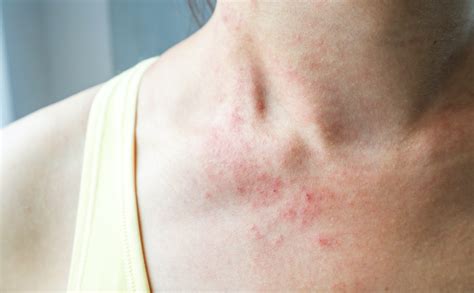 The Causes Of Red Bumps Advanced Dermatology Care